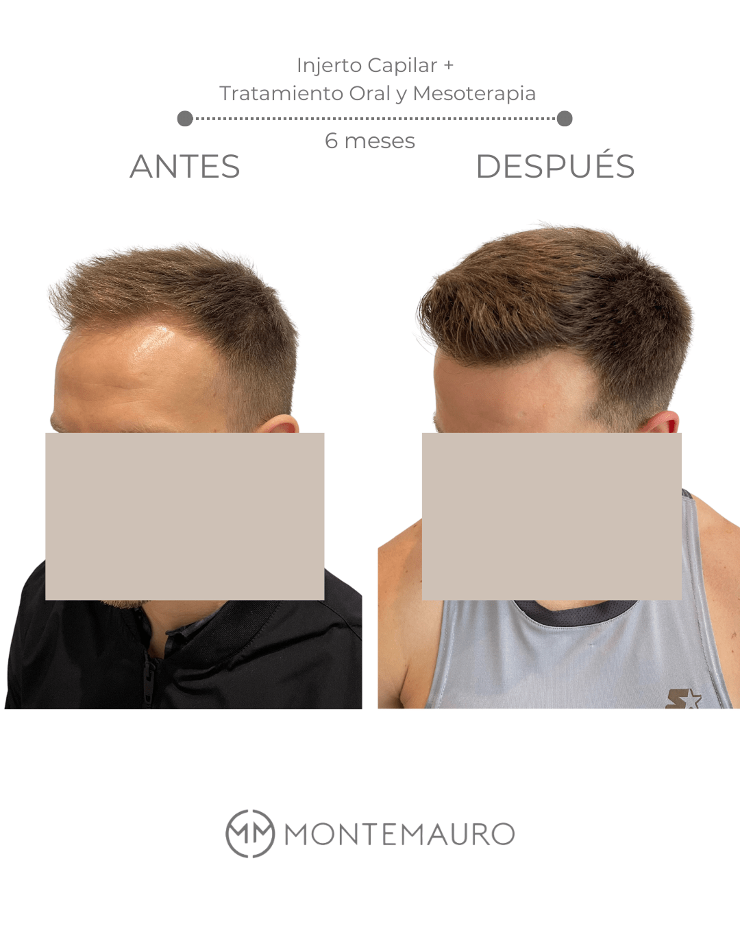 Antes y Después - Joseph 1