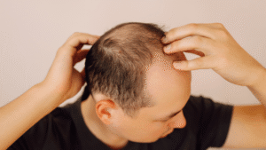 Hombre con signos de alopecia androgenética y pérdida de densidad en la zona frontal