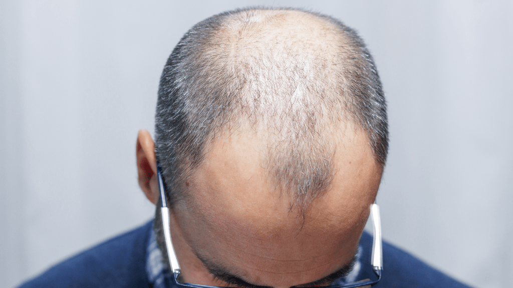 Alopecia androgenética: pérdida de cabello en entradas y coronilla en Madrid alopecia androgenetica hombre perdida cabello entradas coronilla madrid