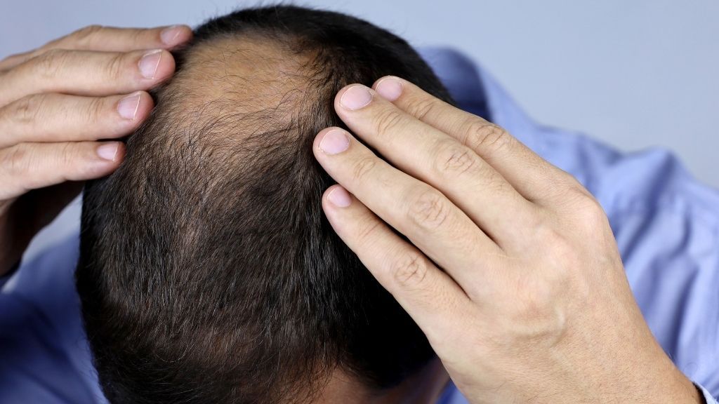 Hombre con pérdida de cabello en la coronilla valorando un injerto capilar en Madrid