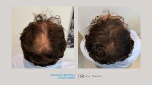 Antes y después de mesoterapia capilar en paciente real del Instituto Montemauro en Madrid