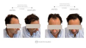 Antes y después de un tratamiento capilar sin cirugía en un paciente real del Instituto Montemauro en Madrid