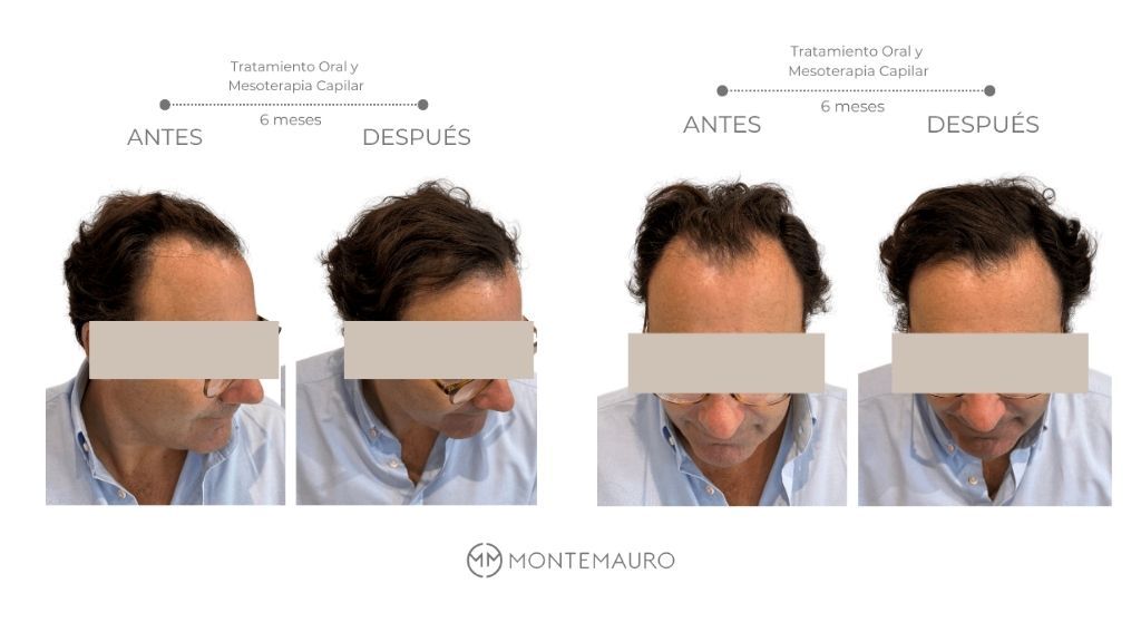 Antes y después de un tratamiento capilar sin cirugía en un paciente real del Instituto Montemauro en Madrid