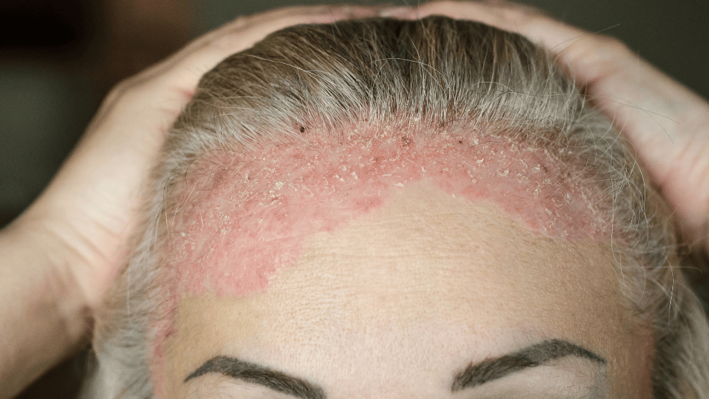 dermatitis seborreica relación con caída de cabello