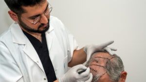 Médico marcando el diseño de la línea frontal antes de un injerto capilar en Madrid