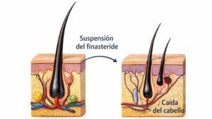 Ilustración médica de un folículo piloso mostrando el efecto del finasteride sobre la dihidrotestosterona (DHT)