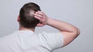 Hombre tocando la coronilla con signos de alopecia androgenética antes de valorar un injerto capilar en Madrid