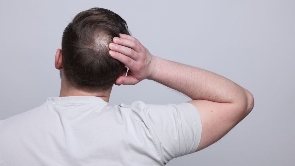 Hombre tocando la coronilla con signos de alopecia androgenética antes de valorar un injerto capilar en Madrid