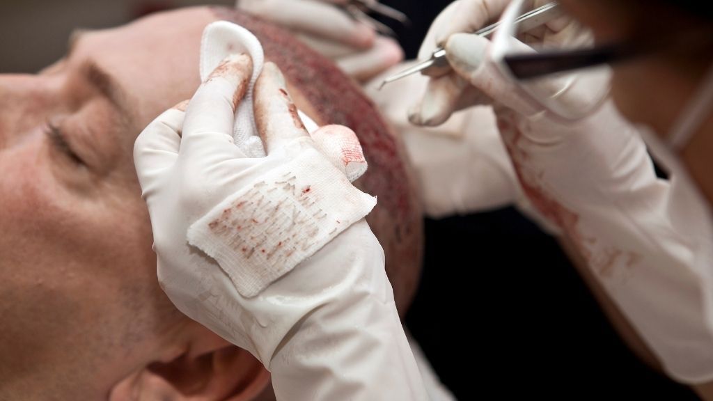 Especialista realizando implantación de folículos durante un injerto capilar FUE en Madrid