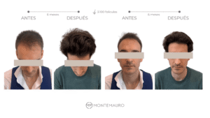foto del caso real del paciente de injerto capilar antes y despues en Madrid Montemauro