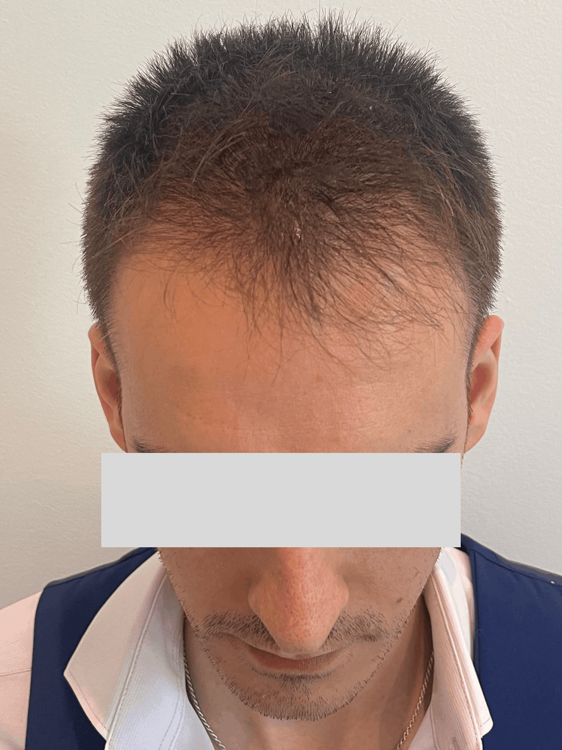 Antes