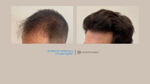 Antes y después de un injerto capilar con pelo fino