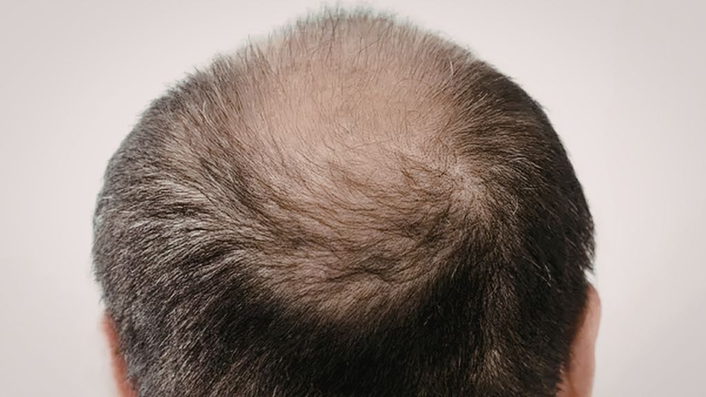 Hombre con pelo fino y pérdida de densidad capilar
