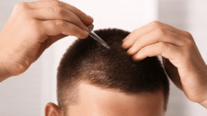 Paciente aplicando minoxidil tópico con pipeta en el cuero cabelludo como tratamiento de mantenimiento tras un injerto capilar.