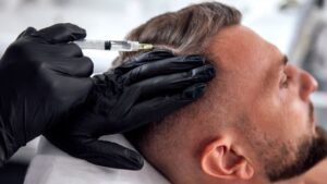 Especialista de la clinica capilar aplicando un tratamiento capilar médico sin cirugía en Madrid